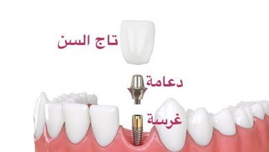 كل ما تحتاج معرفته عن تكلفة زراعة الأسنان في مصر: الأسعار والخيارات المتاحة