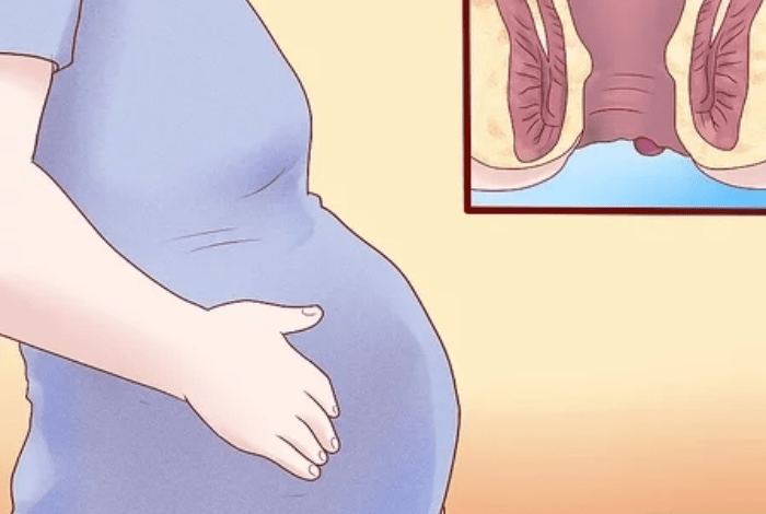 علاج البواسير للحامل في الشهر التاسع